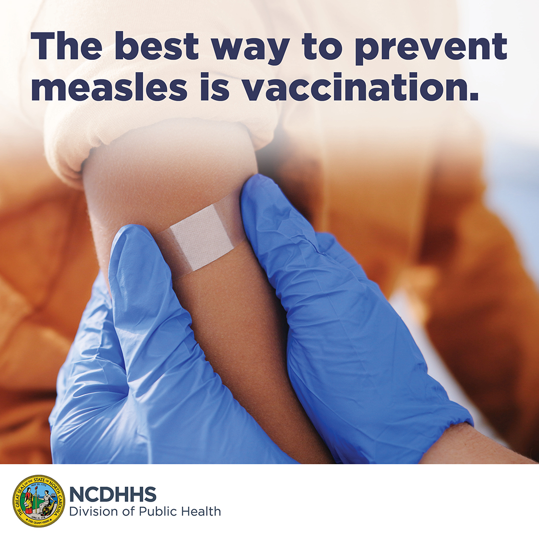 The best way to prevent measles is vaccination.